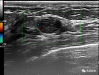 俄研究机构训练人工智能识别早期乳腺癌