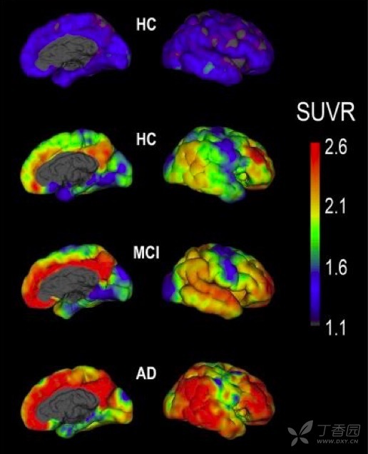 新成像法有望更安全灵活诊断阿尔茨海默病