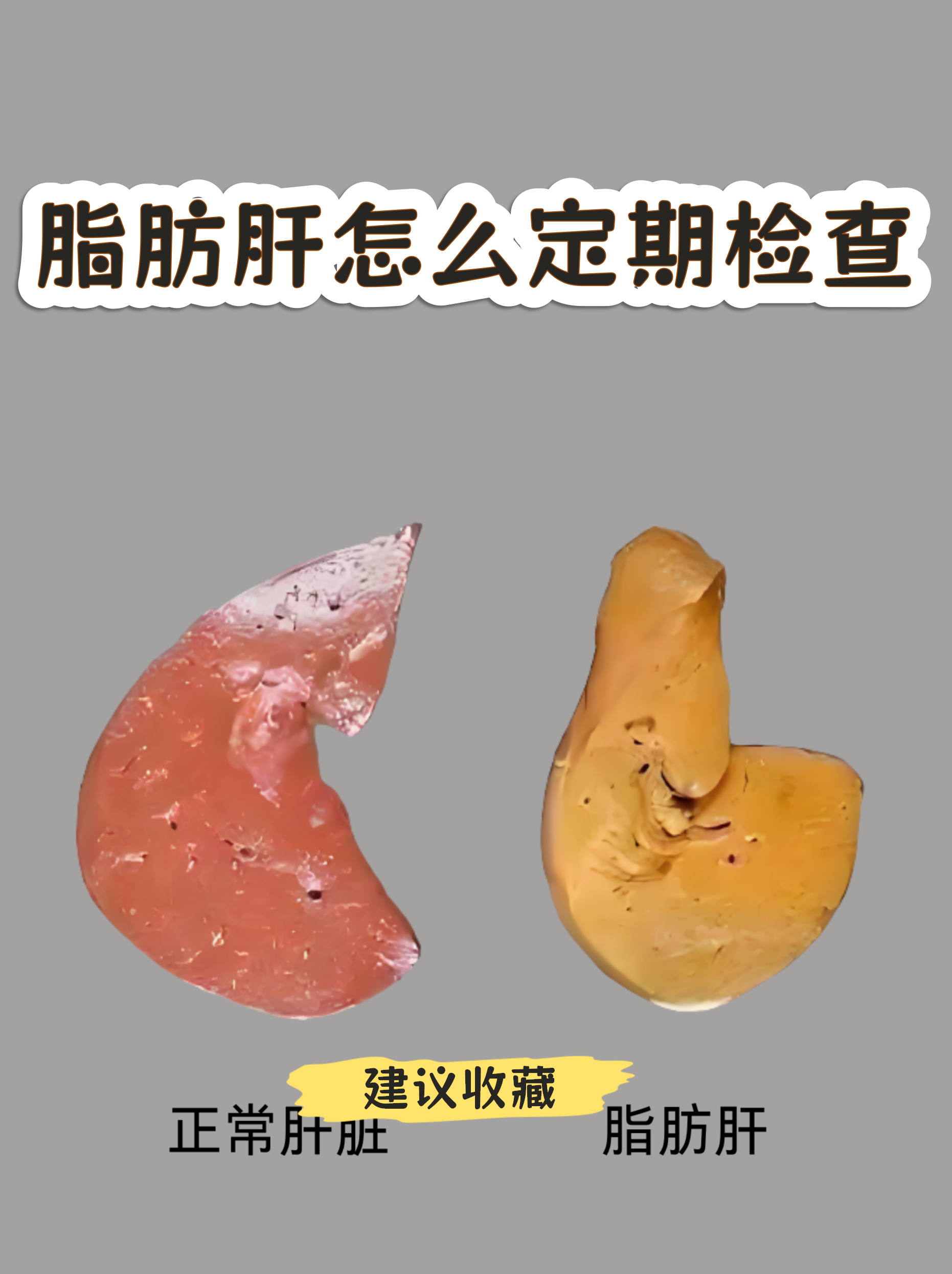 加速代谢相关脂肪肝患者肝纤维化的“隐形杀手”被发现